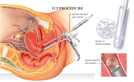 IUI-process-and-sucess